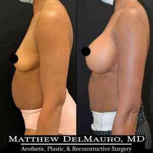 P61-Before-After-4-Months-–-Breast-Augmentation-Silicone4