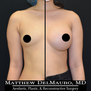 P65-Before-After-5-Months-–-Breast-Augmentation-Silicone1