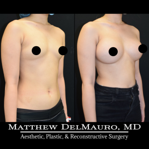 P65-Before-After-5-Months-–-Breast-Augmentation-Silicone3