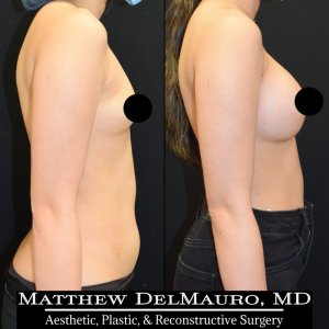 P65-Before-After-5-Months-–-Breast-Augmentation-Silicone4