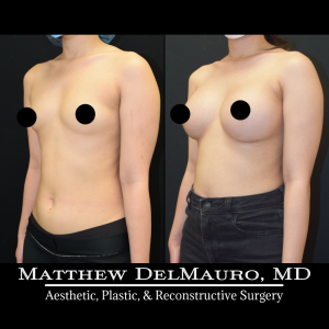 P65-Before-After-5-Months-–-Breast-Augmentation-Silicone5