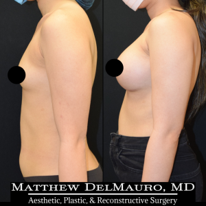 P65-Before-After-5-Months-–-Breast-Augmentation-Silicone6