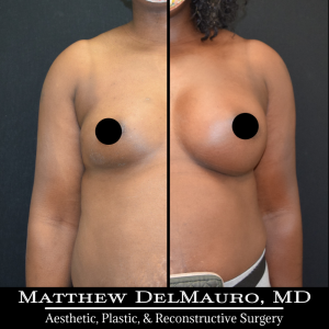 P7-Before-After-4.5-Months-–-Breast-Augmentation-Silicone1