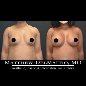 P7-Before-After-4.5-Months-–-Breast-Augmentation-Silicone2