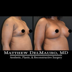 P7-Before-After-4.5-Months-–-Breast-Augmentation-Silicone3