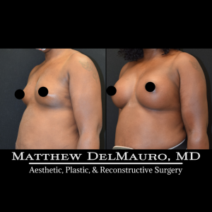 P7-Before-After-4.5-Months-–-Breast-Augmentation-Silicone5