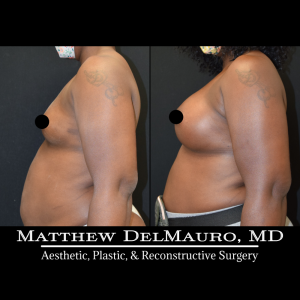 P7-Before-After-4.5-Months-–-Breast-Augmentation-Silicone6