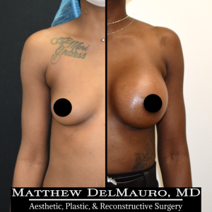 P74-Before-After-1.5-Months-–-Breast-Augmentation-Silicone1