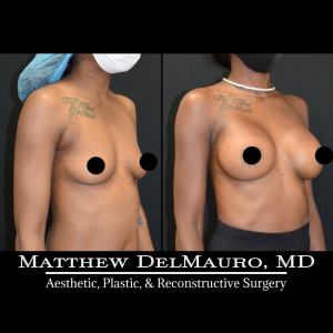 P74-Before-After-3.5-Months-–-Breast-Augmentation-Silicone1