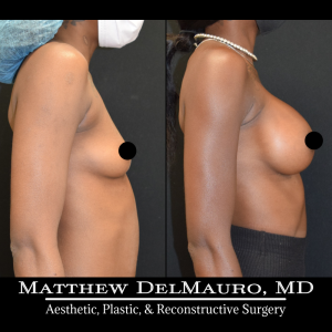 P74-Before-After-3.5-Months-–-Breast-Augmentation-Silicone2