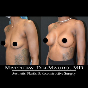 P74-Before-After-3.5-Months-–-Breast-Augmentation-Silicone3