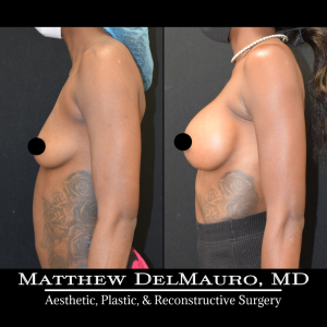 P74-Before-After-3.5-Months-–-Breast-Augmentation-Silicone4