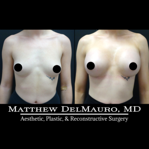 P76-Before-After-1-Months-–-Breast-Augmentation-Silicone2