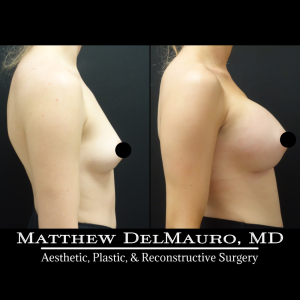 P76-Before-After-1-Months-–-Breast-Augmentation-Silicone4