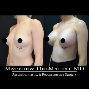 P76-Before-After-1-Months-–-Breast-Augmentation-Silicone5