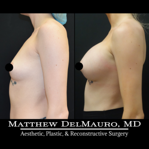 P76-Before-After-1-Months-–-Breast-Augmentation-Silicone6