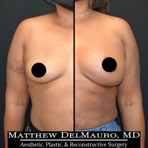 P78-Before-After-4-Months-–-Breast-Augmentation-Silicone1