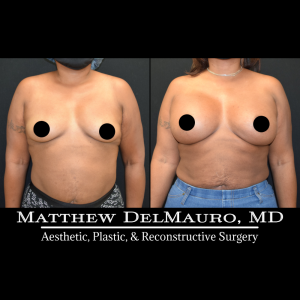 P78-Before-After-4-Months-–-Breast-Augmentation-Silicone2