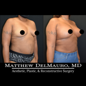 P78-Before-After-4-Months-–-Breast-Augmentation-Silicone3