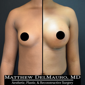 P83-Before-After-1-Months-Breast-Augmentation-Silicone1