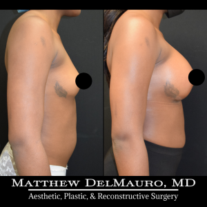 P83-Before-After-1-Months-Breast-Augmentation-Silicone4