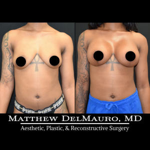 Before-After-3.5-Months-–-Breast-Lift-Vertical-with-Implants-Silicone2