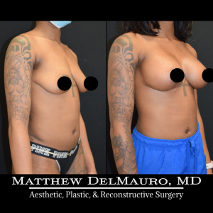 Before-After-3.5-Months-–-Breast-Lift-Vertical-with-Implants-Silicone3