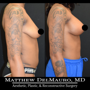 Before-After-3.5-Months-–-Breast-Lift-Vertical-with-Implants-Silicone4