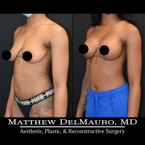 Before-After-3.5-Months-–-Breast-Lift-Vertical-with-Implants-Silicone5