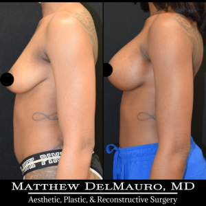 Before-After-3.5-Months-–-Breast-Lift-Vertical-with-Implants-Silicone6