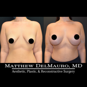 Before-After-4-Months-–-Breast-Lift-Circumareolar-with-Implants-Silicone1