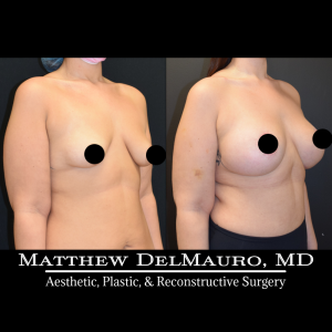 Before-After-4-Months-–-Breast-Lift-Circumareolar-with-Implants-Silicone2