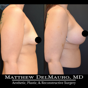 Before-After-4-Months-–-Breast-Lift-Circumareolar-with-Implants-Silicone3