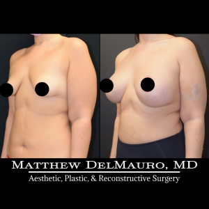 Before-After-4-Months-–-Breast-Lift-Circumareolar-with-Implants-Silicone4