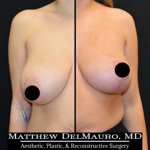 Before-After-4-Months-–-Breast-Lift-Inverted-T-with-Autoaugmentation1