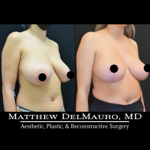 Before-After-4-Months-–-Breast-Lift-Inverted-T-with-Autoaugmentation3