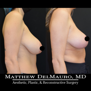 Before-After-4-Months-–-Breast-Lift-Inverted-T-with-Autoaugmentation4