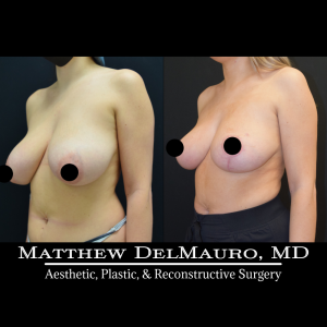 Before-After-4-Months-–-Breast-Lift-Inverted-T-with-Autoaugmentation5