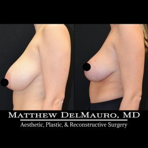 Before-After-4-Months-–-Breast-Lift-Inverted-T-with-Autoaugmentation6