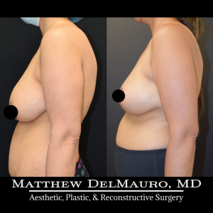 Before-After-4.5-Months-–-Breast-Lift-Inverted-T