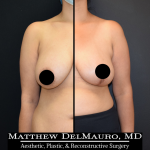 Before-After-4.5-Months-–-Breast-Lift-Inverted-T1