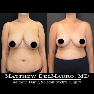 Before-After-4.5-Months-–-Breast-Lift-Inverted-T2