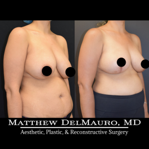 Before-After-4.5-Months-–-Breast-Lift-Inverted-T3