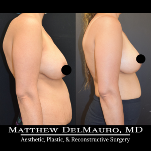 Before-After-4.5-Months-–-Breast-Lift-Inverted-T4