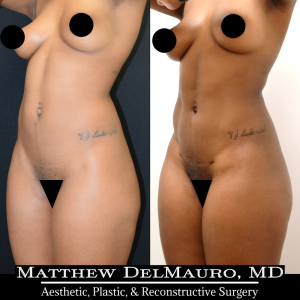 Before-After-6.5-Months-–-Abdominal-Liposuction4